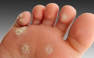 Removal of calluses and warts