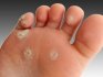 Removal of calluses and warts